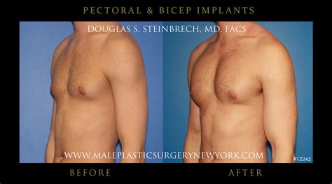 Pectoral And Bicep Implants Pectoral And Bicep Implants Proced Flickr