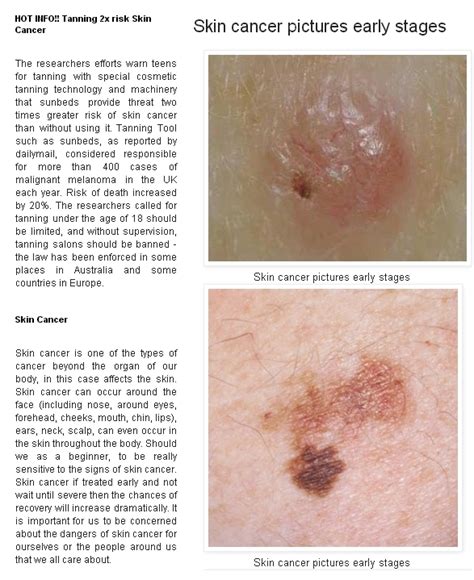 Early Stages Of Skin Cancer Skin Cancer Advices