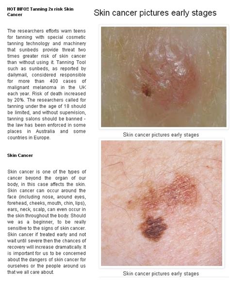 Photos of early penile cancer. Early pictures of skin cancer | Skin Cancer Advices