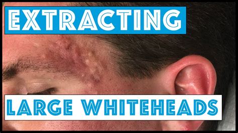 Acne Vulgaris And Extracting Large Whiteheads Part 1