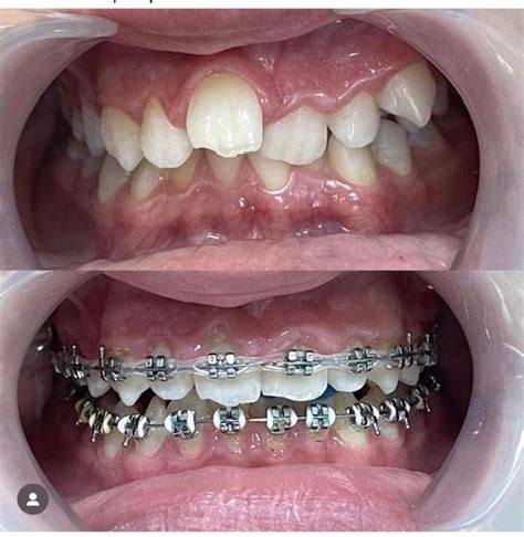 10 How To Draw Braces