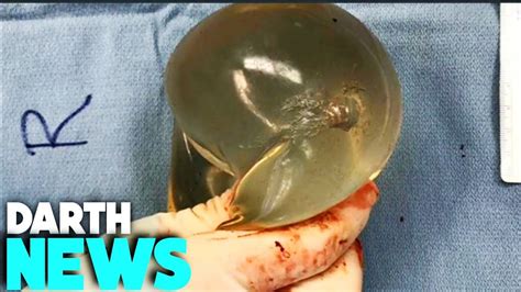 Woman S Life Saved After Breast Implants Deflect Bullet Away From Her