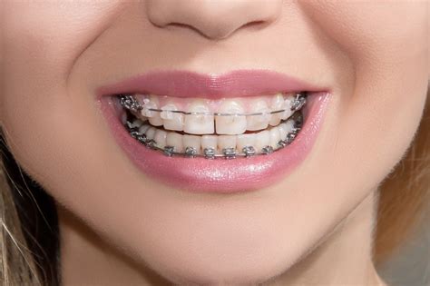 How Do Braces Move Teeth Ph
