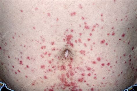Allergic Purpura On The Abdomen Stock Image C0111680 Science