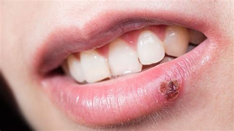 Cold Sores Causes Symptoms And Other Risk Factors