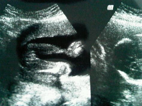 Pemeriksaan ultrasonografi (usg) adalah hal yang sangat dianjurkan untuk perempuan hamil. Foto Usg Kelamin Janin Perempuan - foto cewek cantik