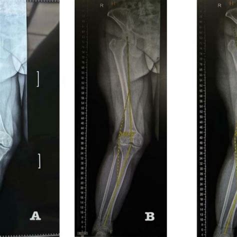 A Radiological Imaging Shows Severe Valgus Deformity Knee B Shows