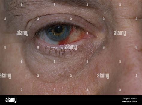 Bleeding Eye Hi Res Stock Photography And Images Alamy