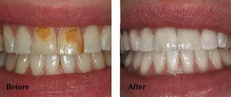 To insert your veneers, slip the snap on teeth over your own front teeth and apply gentle pressure to. Tooth veneer and teeth veneers | Ealing Dental Practice