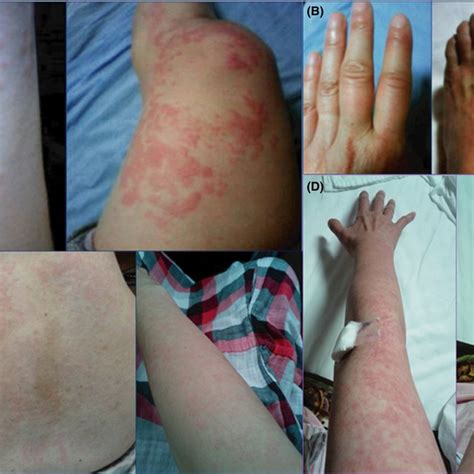 The Various Rashes Seen In Our Patient A Urticaria Of The Arms And