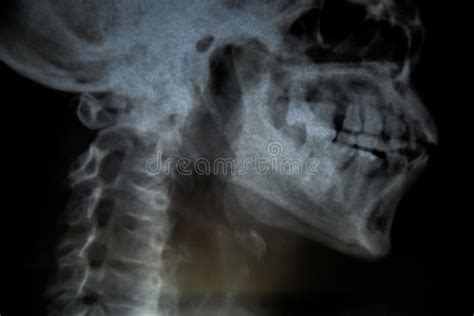 Film X Ray Skull Lateral Stock Image Image Of Bone Science 91043219