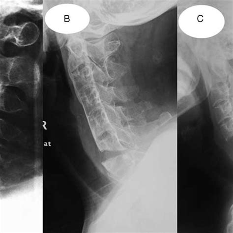 Outcome Of Cervical Spine Fractures In Ankylosing Spondylitis