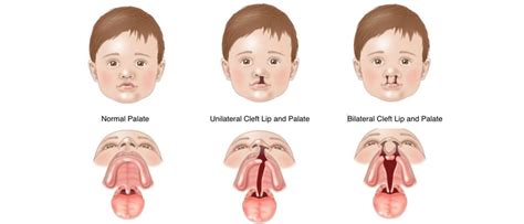 Cleft Palate Vs Cleft Lip