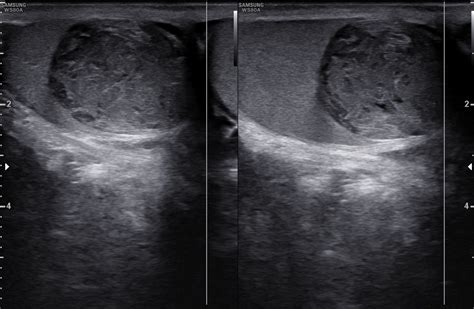 Testicular Epidermoid Cyst Image