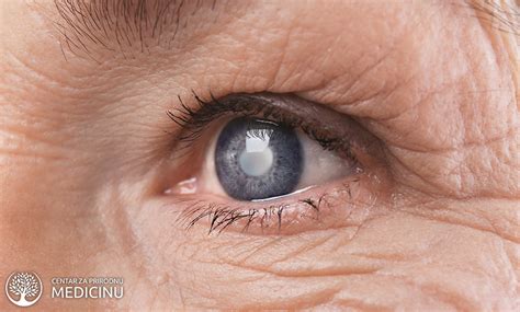 Glaukom O Ni Pritisak Uzrok Simptomi I Le Enje Prirodnim Putem
