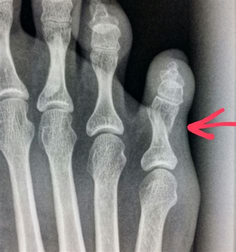 X Ray Of Foot With Toe Fracture