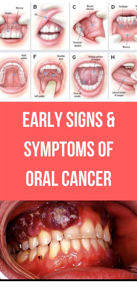 Early Signs Symptoms Of Oral Cancer Wellness Rise