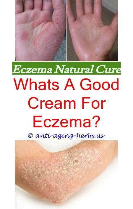 Eczema Dyshidrotic Eczema Groin Images