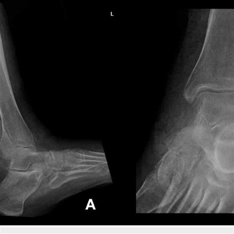 Plain Radiograph Of Lateral A View And Medial B View Of The Left