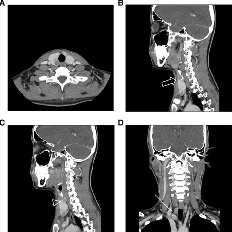Contrast Enhanced Ct Of Multiple Parathyroid Adenomas In A 23 Year Old
