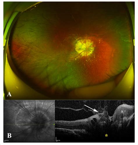 A Widefield Color Fundus Photograph Of The Right Eye Revealed A