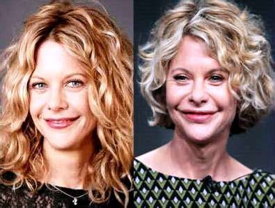 Meg Ryan Plastic Surgery Before And After Photos Lip Implants Botox