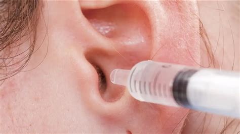 How To Get Rid Of Earwax Blockage Youtube