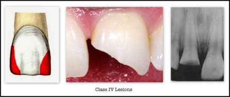Gv Blacks Classification Of Caries Dentodontics