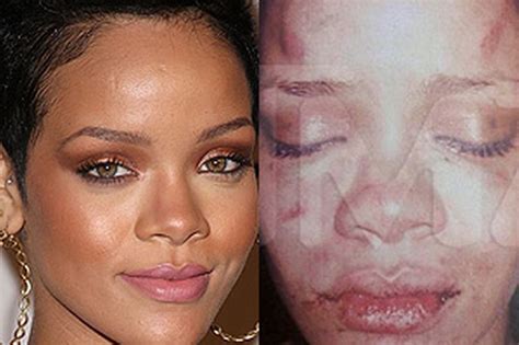 Rihanna S Battered Face Leaked Picture Shows Injuries After Alleged