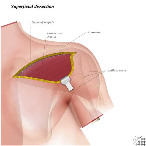 The shoulder isn't just one bone, it's actually made up of three different bones and various tendons, ligaments, and muscles.the three bones located in the shoulder are the humerus, the scapula, and the clavicle. Shoulder Muscles Diagram Posterior / What Is Whiplash Diller Law : Shoulder muscles and shoulder ...