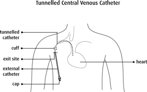 Central Venous Catheter Canadian Cancer Society