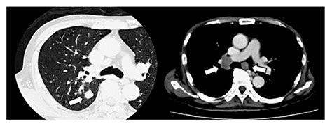 Contrast Enhanced Ct Scans Revealed A Right Lung Tumor With A Size Of