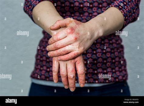 Young Womans Hands With Dry And Stressed Red Dyshidrotic Eczema Stock