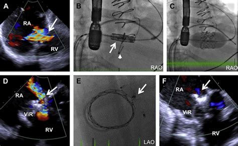 Transcatheter Tricuspid Valve Replacement Interventional Cardiology