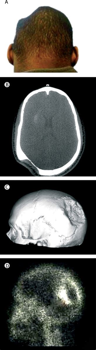 A Dent In The Head The Lancet