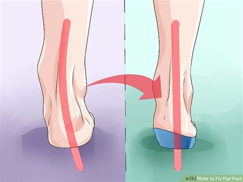 A significant segment of the population (estimates range from 8% to. 3 Ways to Fix Flat Feet - wikiHow