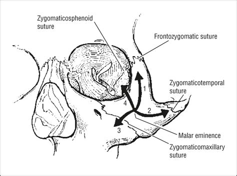 Zygomaticomaxillary Complex Fractures | JAMA Facial ...