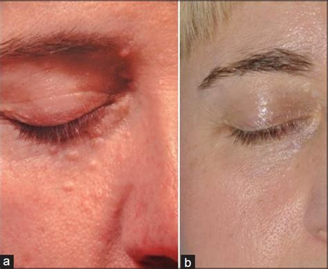 Sebaceous hyperplasia is completely benign and does not require treatment; Dermatological applications of carbon dioxide Laser Madan ...
