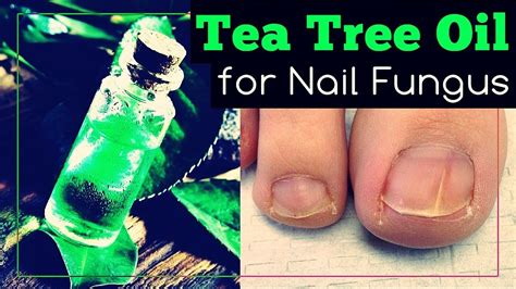 Tea Tree Oil For Nail Fungus How To Use It Youtube