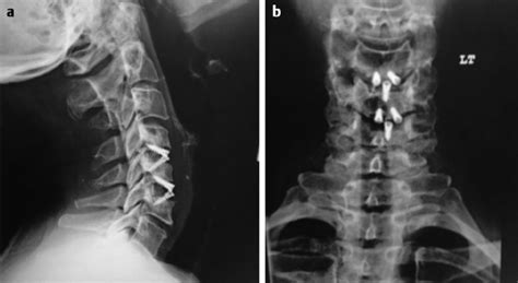 Anterior Cervical Discectomy Fusion And Instrumentation Neupsy Key
