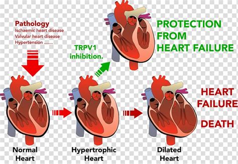 Heart Failure Ventricular Hypertrophy Cardiovascular Disease Heart