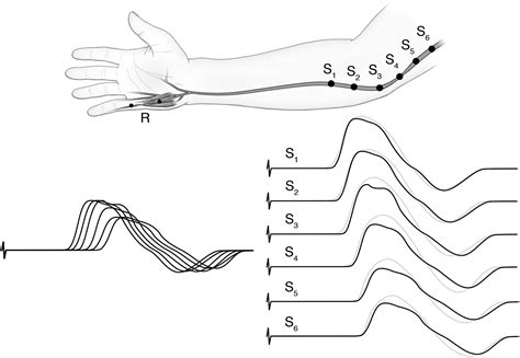 Nerve Conduction Studies Basic Concepts And Patterns Of Abnormalities