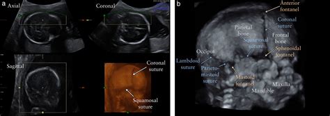 Three‐dimensional Ultrasound Imaging Of The Fetal Skull And Face