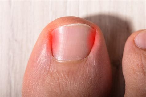 Heres Why You Should Never Ignore An Ingrown Toenail Gelbmann Podiatry