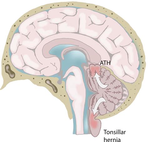 Types Of Cerebral Herniation And Their Imaging Features Radiographics