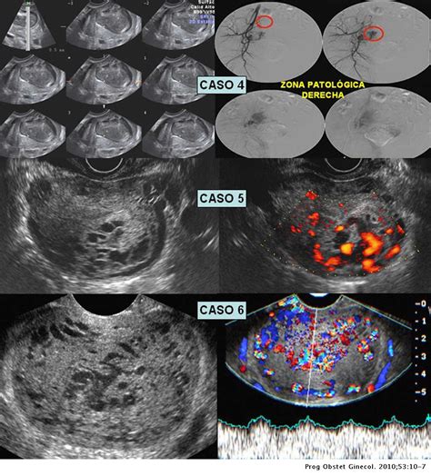 La Malformación Arteriovenosa Uterina Una Lesión Más Frecuente Y Grave