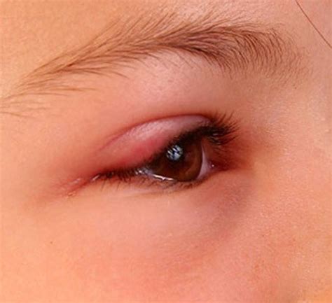 Swollen Eyelid Symptoms Treatment Pictures Causes Youmemindbody