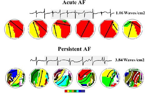 Inter-individual variation in characteristics of fibrillation waves ...