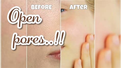 How To Shrink Our Open Pores 100 Effective Home Remedy For Open