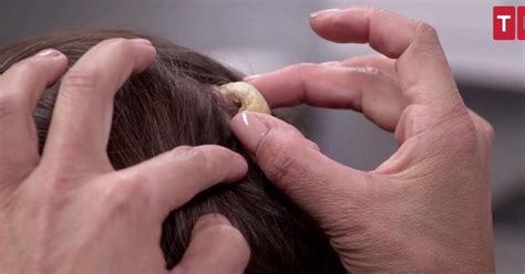 Dr Pimple Popper Grapples With Keloids On A Patients Ears
